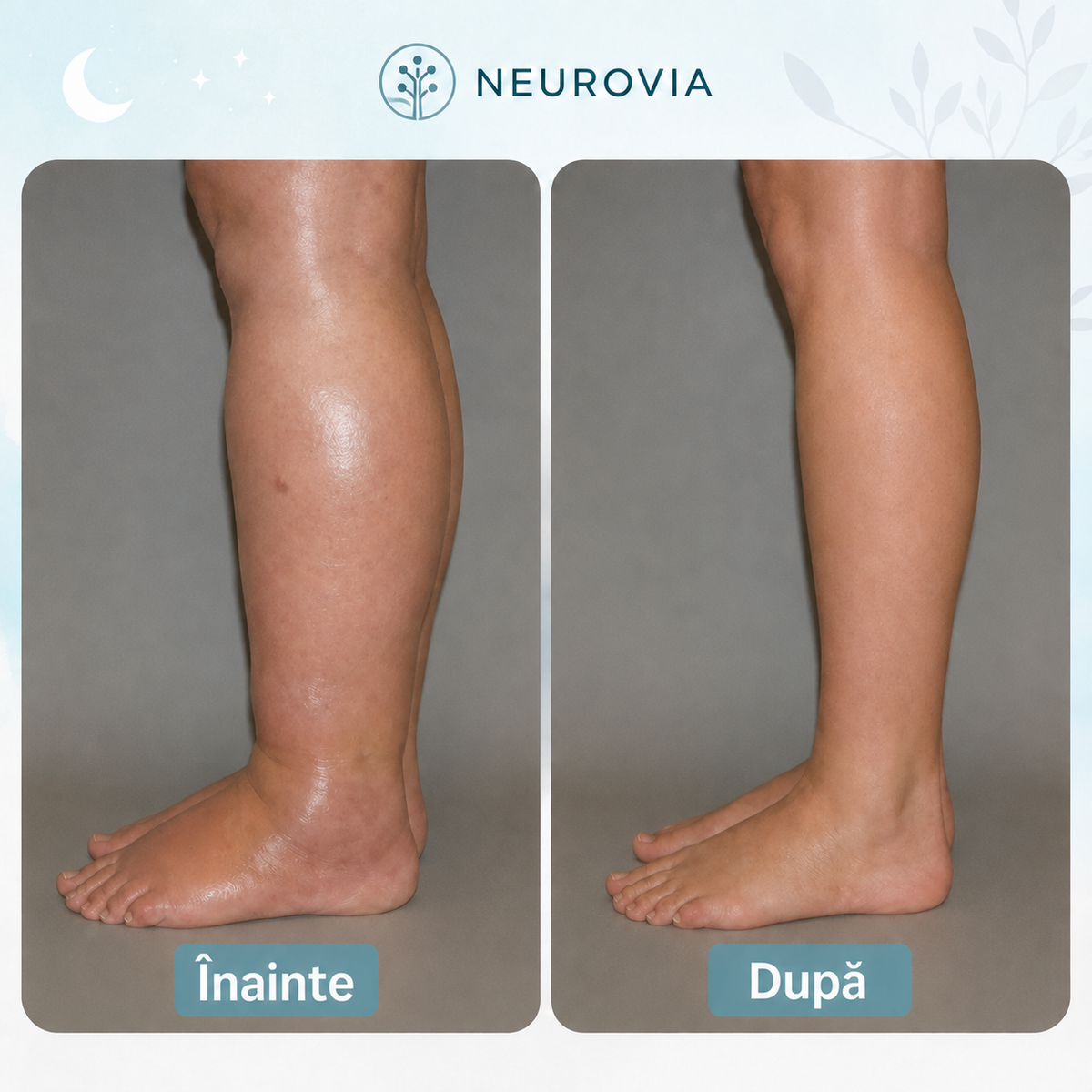 1+1 GRATIS AZI - Neurovia™ Tratament EMS pentru picioare umflate, grele sau slăbite – utilizare confortabilă acasă